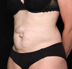 Tummy Tuck Before & After Patient #34348